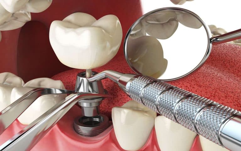 Dental Implants in Vancouver