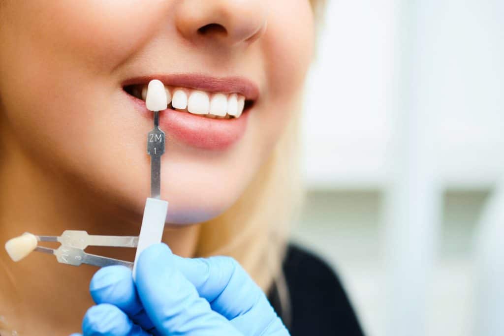 Porcelain Veneers in Vancouver