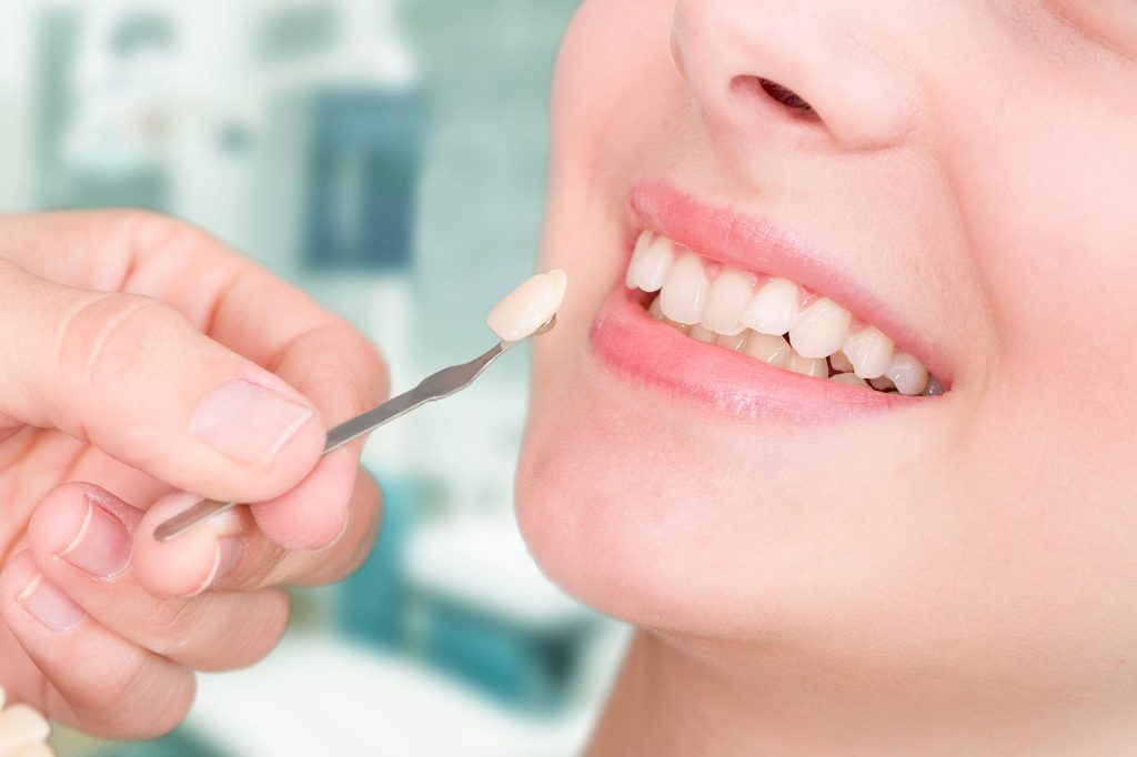 Dental Porcelain Veneers in Vancouver