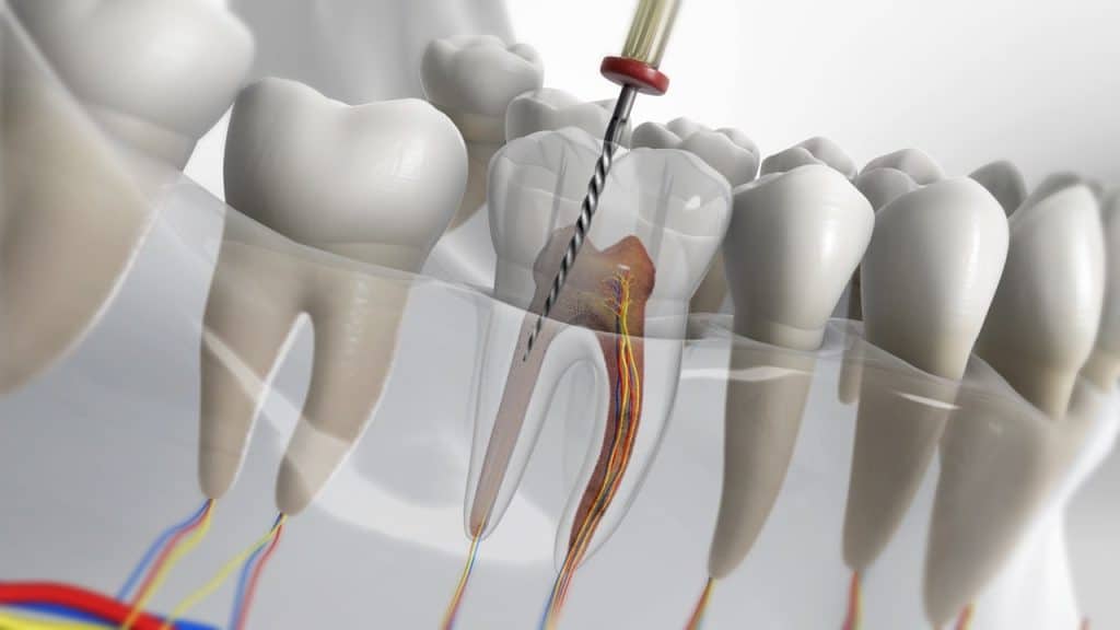 Root Canal Therapy