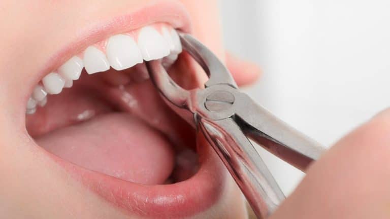 Tooth Extractions in Vancouver