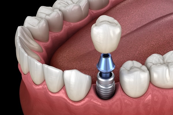 Repair Your Implant Crown