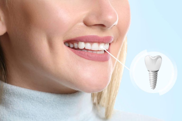 Implant a Tooth Right After Taking One Out