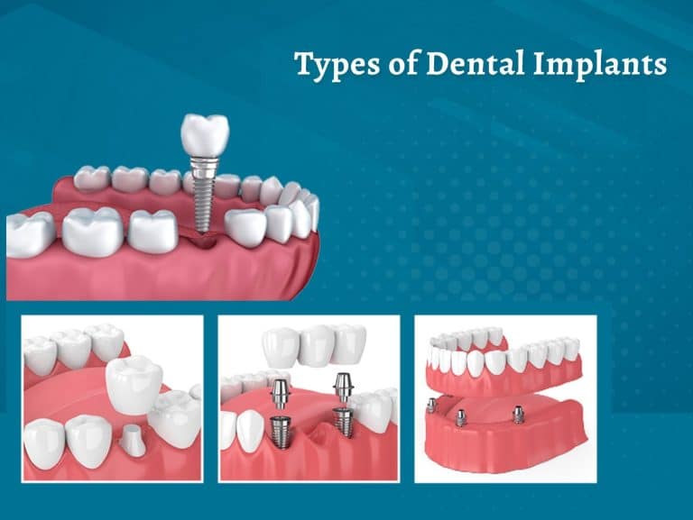 Different Types of Dental Implants